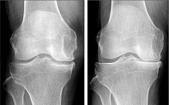 arthrosis kezelés előtt és után Hondrofrosttal