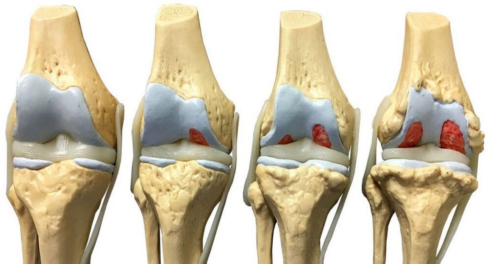 arthrosis kezelésére Hondrofrost