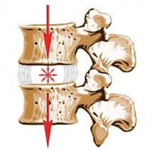 A gerinc eszköze és az osteochondrosis okai