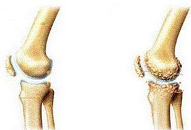 egészséges ízület és ízületi arthrosis