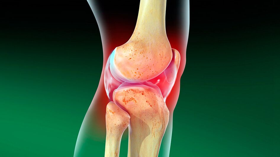 A térdízület osteoarthritis