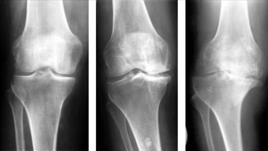 A térdízület arthrosisának 3 szakasza